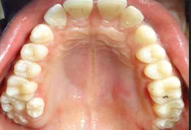 <p>type of hyperdontia </p>