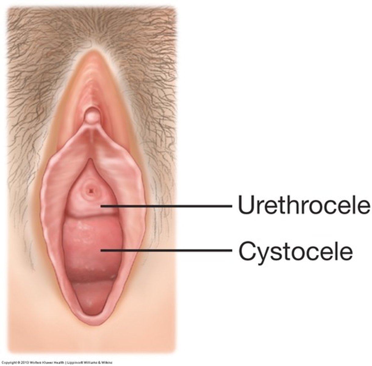<p>bulging of the anterior vaginal wall, bladder, and urethra</p>
