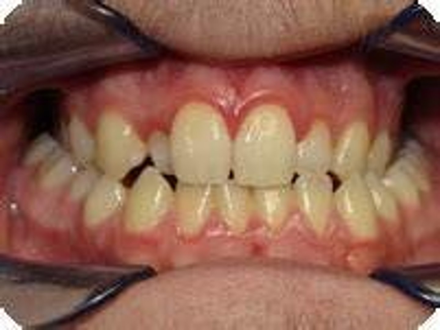 <p>When the mandibular posterior teeth sit more to the buccal than the maxillary posterior teeth, it is termed:</p>