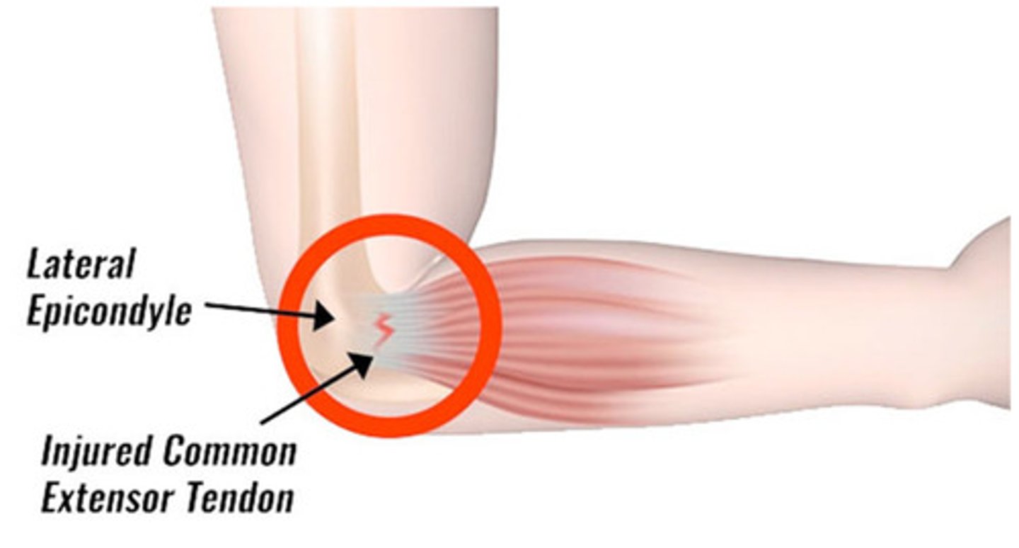 <p>painful inflammation of the tendon at the outer border of the elbow resulting from overuse of lower arm muscles (as in twisting of the hand)</p>