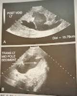 <p>A 6 year child w/fever, chills, and back pain was seen for a renal sonogram. The kidneys were markedly enlarged, and the findings in the image were noted. What is the most likely diagnosis.</p>