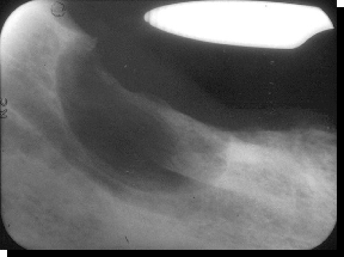 <p>benign tumors have what affect on the IAN canal?</p>