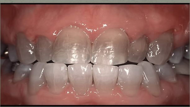 <p>Drug-Induced Stains and Discolorations: Minocycline</p>