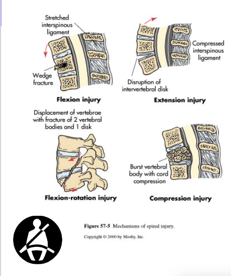 <ul><li><p>Hyperextension: Excessive posterior movement of head or neck. Extension injuries.</p></li><li><p>Hyperflexion: Excessive anterior movement of head onto chest. Flexion Injuries.</p></li><li><p>Compression: weight of the head or pelvis into a stationary neck or torso. Diving into shallow water.</p></li><li><p>Rotation: Excessive rotation of head/neck or torso</p></li></ul><p></p>