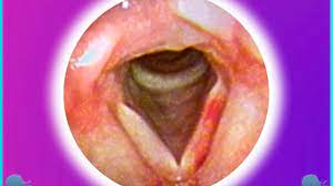 <ul><li><p>organic, structural</p></li><li><p>bruise, broken blood vessels</p></li><li><p>can form in one moment of voice use</p></li></ul>