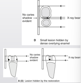 <ul><li><p>caries depth relative to the pulp; may appear the pulp is involved when it is not </p></li><li><p>tooth w a broad contact does NOT show caries as well as a greater density tooth structure surround caries </p></li></ul><p></p>