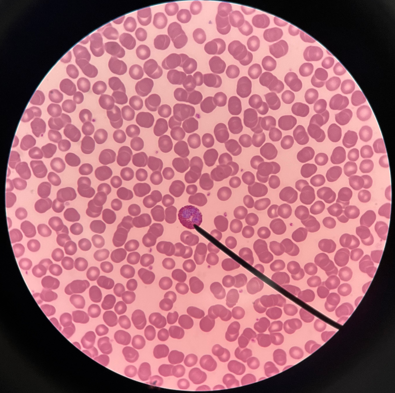 • Leukocyte and granulocyte.

• Appears with a bilobed nucleus with rosy red-stained granules.

• Attacks parasites by releasing toxic substances.

• Count increased by parasitic infection.

• Count decreased by stress.