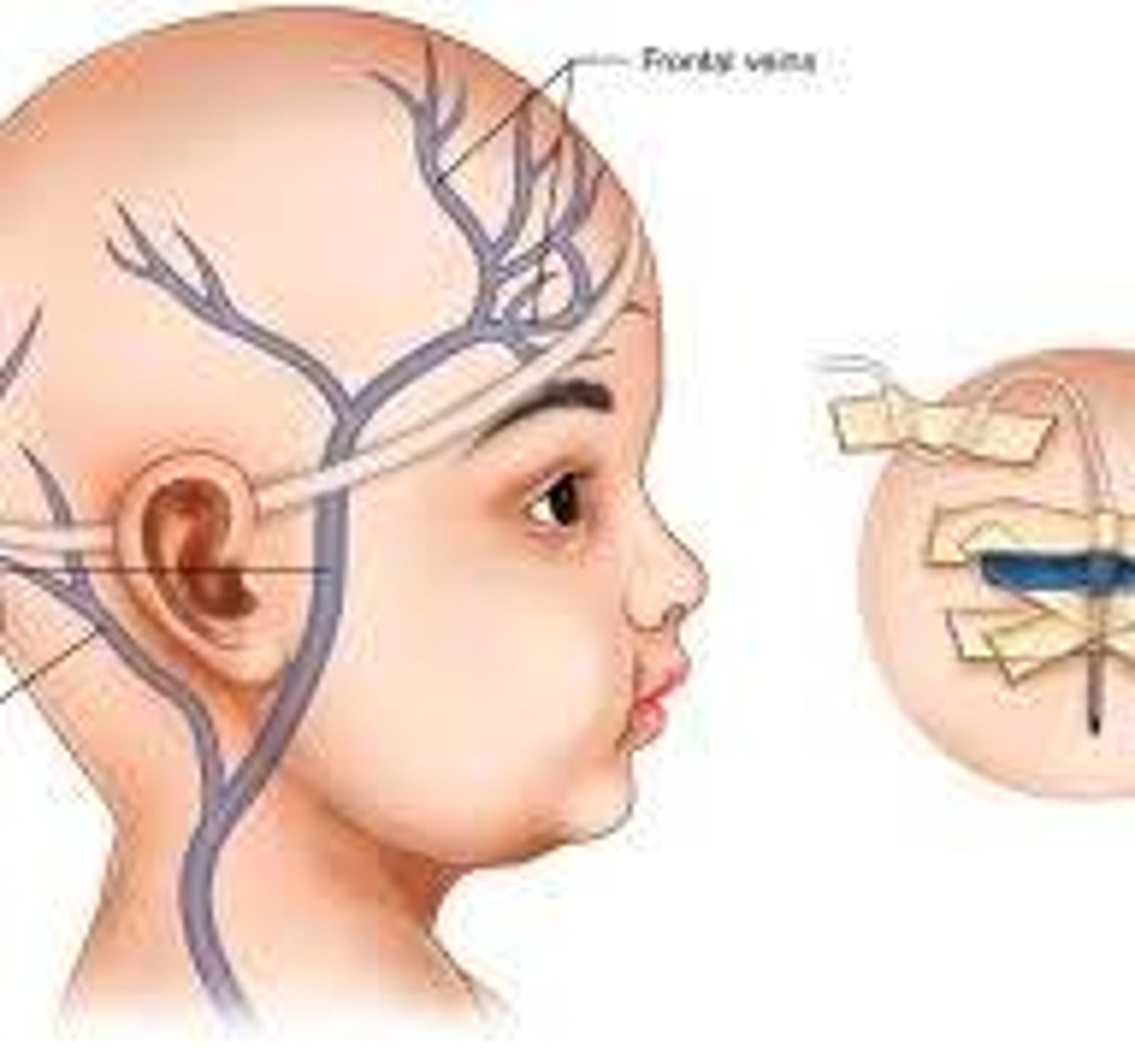 <p>long-standing increased intracranial pressure</p>