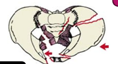 <p>Pelvic Fracture</p>