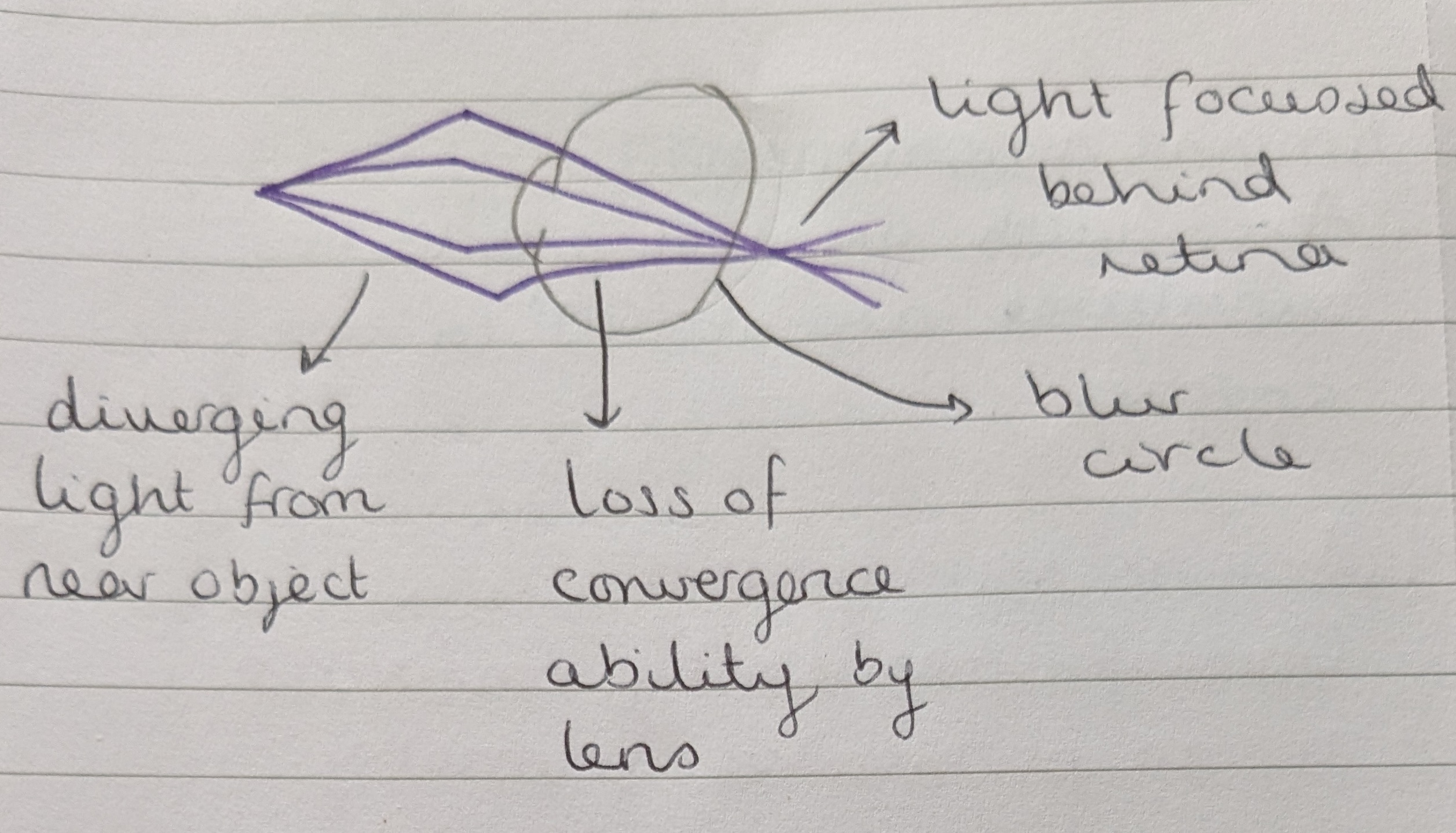<p>False - presbyopia is not a true refractive error, but instead a natural part of the aging process wherein the lens gradually loses its ability to adjust its power to near objects. </p>