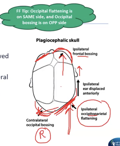<ul><li><p>results from prolonged asymmetrical pressure on the premature skull</p></li><li><p>creates a parallelogram shape when viewed from the vertex (top-down)</p></li><li><p>named after the side of the flattening </p></li><li><p>occipitoparietal flattening and contralateral occipital bossing</p><ul><li><p>bossing is if you push on the back of the head, it will push out on the front side of the head, same side on the front</p></li></ul></li><li><p>ipsilateral frontal bossing and anterior displacement of the ear</p></li><li><p>assess C/S ROM and strength, educate parents on positioning, exercises, helmet, and tummy time </p></li></ul><p></p>