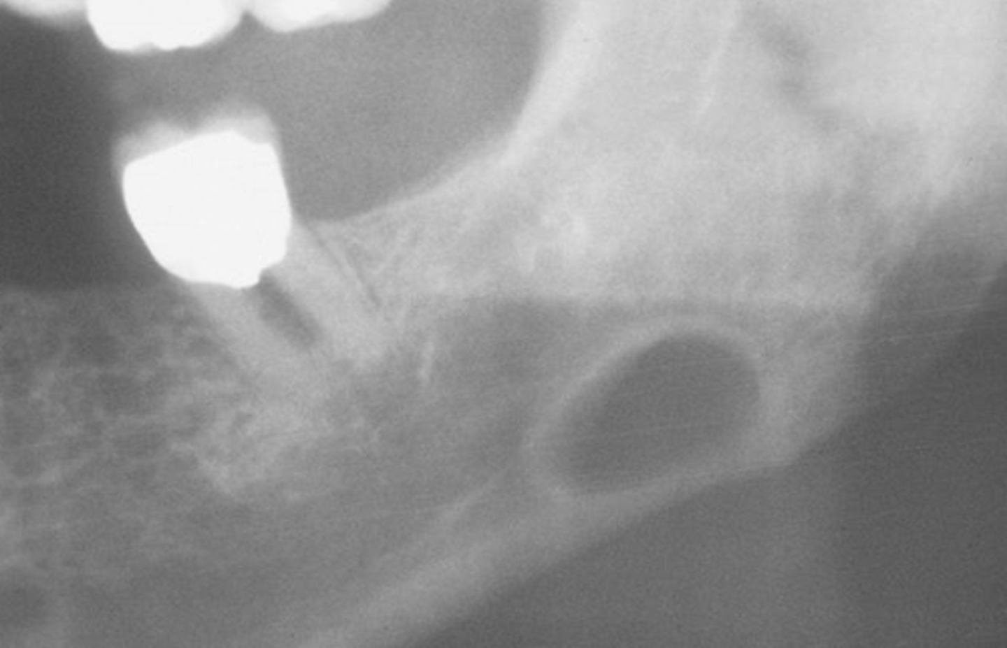 <p>rule out lesions associated w/ tooth development</p><p>i.e. stafne defect</p>