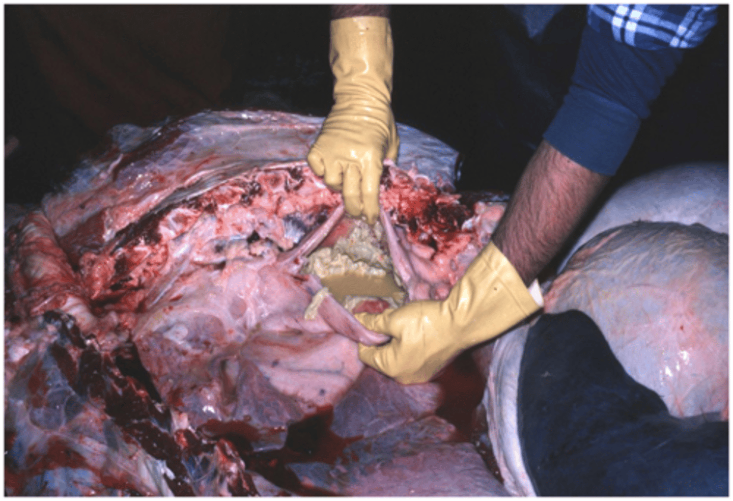 <p>Pericarditis where pericardial space is invaded by infection that enters due to neighboring inflammation</p>
