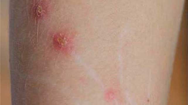 <p>caused by bartonella nenselae </p><p>type: aerobic, gram negative </p><ul><li><p>mild infections that usually goes away on its own </p></li><li><p>creates a pore, like a straw to take nutrients from inside the red blood cell </p></li><li><p>common in cats ( acquired through fleas ) </p></li></ul><p></p>