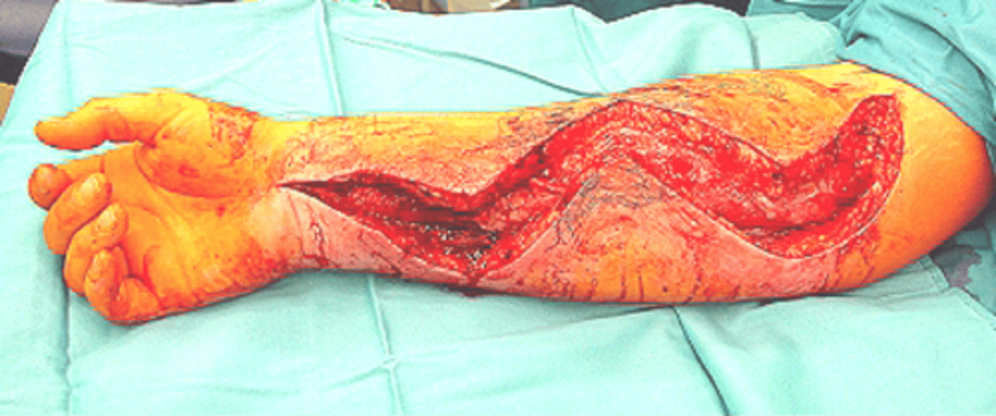<p>Fasciotomy</p>