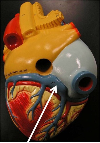 <p>enlarged vessel on the posterior aspect of the heart that empties blood into the right atrium</p>