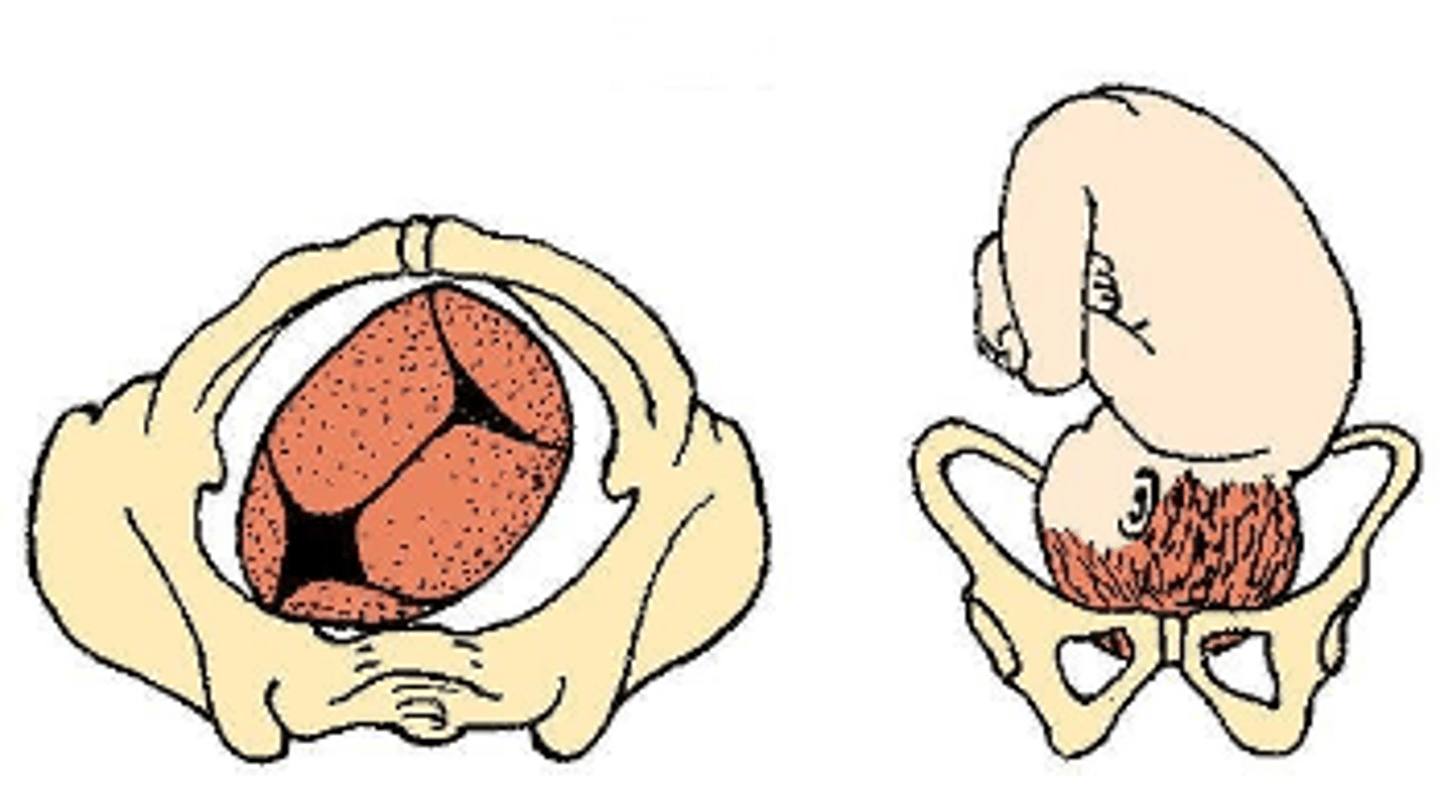 <p>A. Cephalic presentation, Left Occiput anterior (LOA)</p>