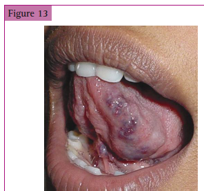 <p>__________ of the tongue</p>