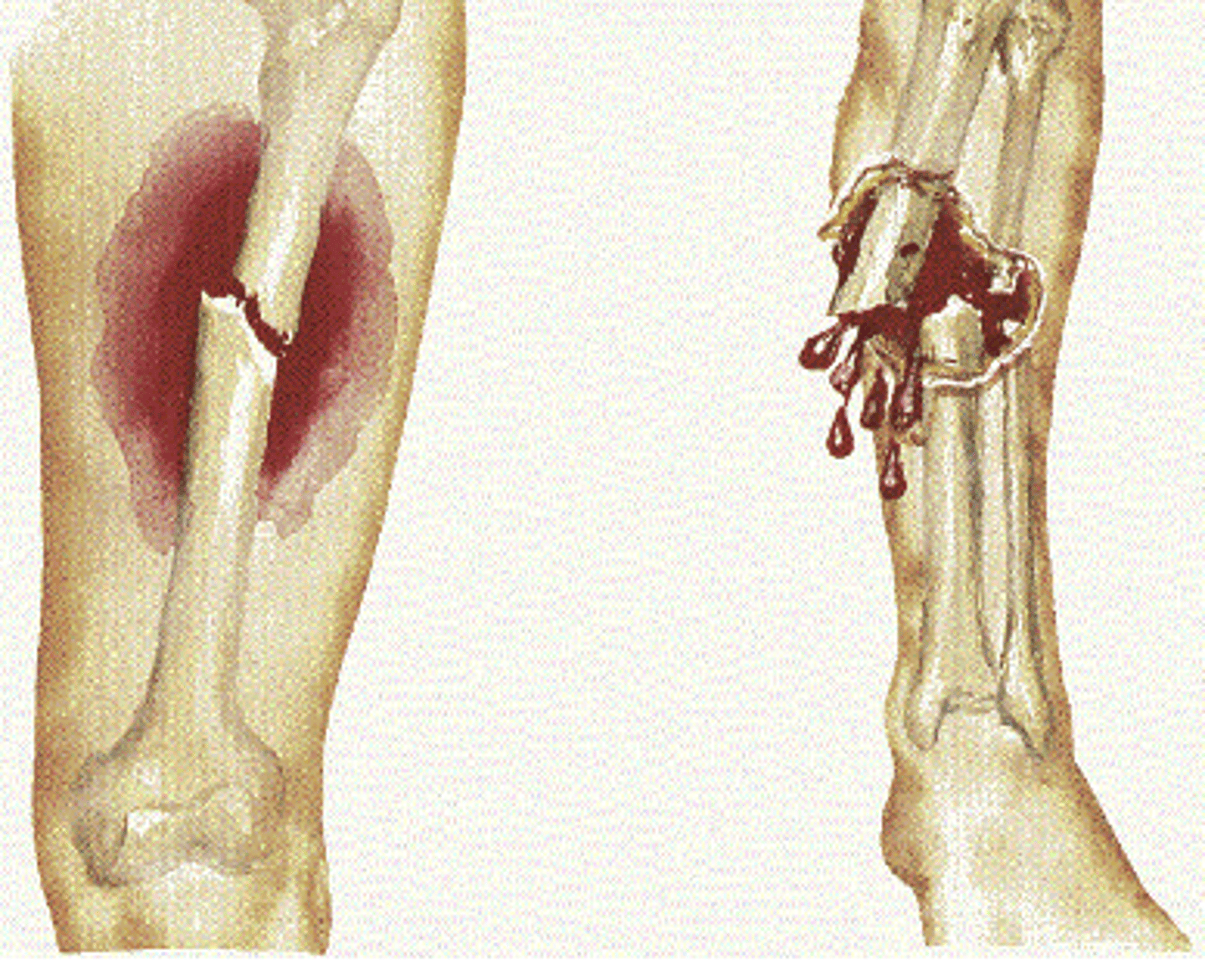 <p>what is an immediate concern with an open fracture?</p>