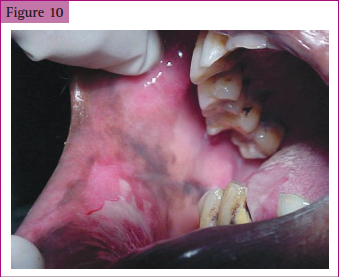 <p>______________ of buccal mucosa following traumatic ulceration</p>