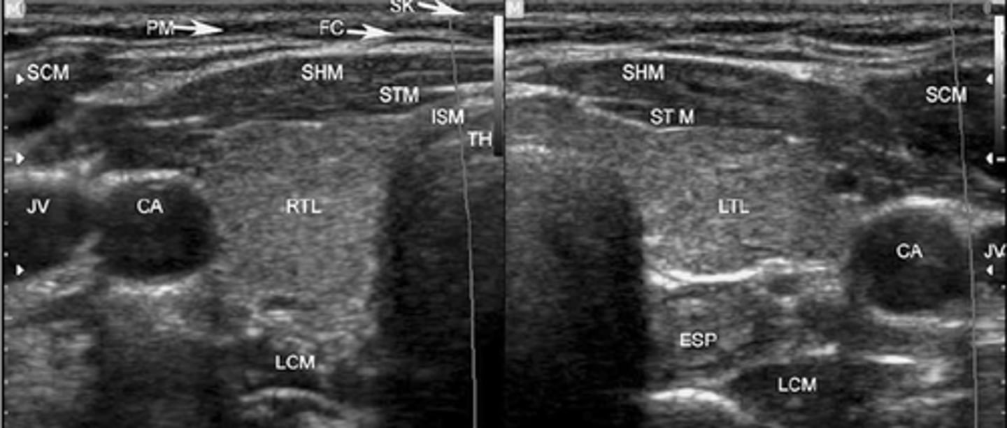 <p>-Thyroid lobes and isthmus appear as homogeneous solid structures demonstrating a medium-gray echo pattern with a surrounding thin hyperechoic line</p><p>-Sternocleidomastoid muscle are large and oval in shape appearing hypoechoic compared with the normal thyroid gland</p><p>-Strap muscles are thin and hypoechoic compared with the normal thyroid gland</p><p>-Longus colli muscles appear hypoechoic compared with the normal thyroid gland</p>