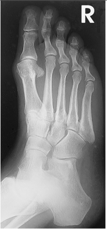 <p><span style="line-height: normal;"><span> </span></span>Entire foot visualized</p><p class="p1"><span style="line-height: normal;"><span> </span></span>Third<span style="line-height: normal;"><span> </span></span>through fifth metatarsal bases free of superimposition</p><p class="p1"><span style="line-height: normal;"><span> </span></span>Bases of 1<span style="line-height: normal;"><span>st</span></span> – 2<span style="line-height: normal;"><span>nd</span></span> are overlapped</p><p class="p1"><span style="line-height: normal;"><span> </span></span>Tuberosity demonstrated at base of fifth metatarsal</p><p class="p1"><span style="line-height: normal;"><span> </span></span>Sinus tarsi visualized</p><p class="p1"><span style="line-height: normal;"><span> </span></span>Cuboid-cuneiform joint space is open</p>