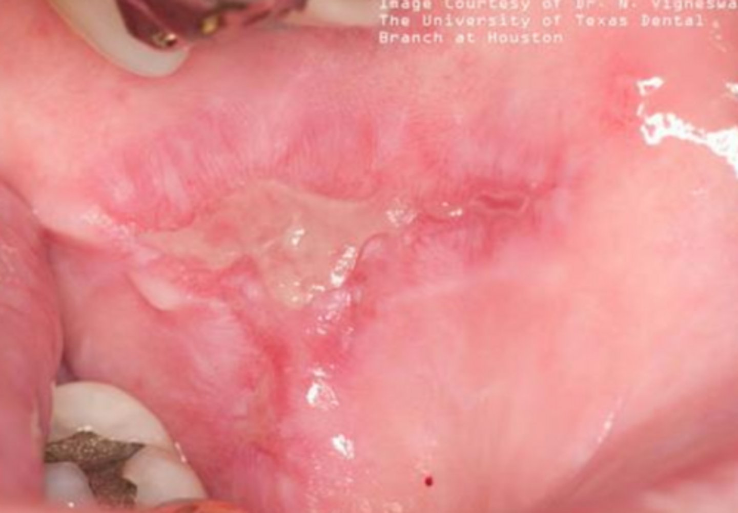 <p>erosive lichen planus</p>