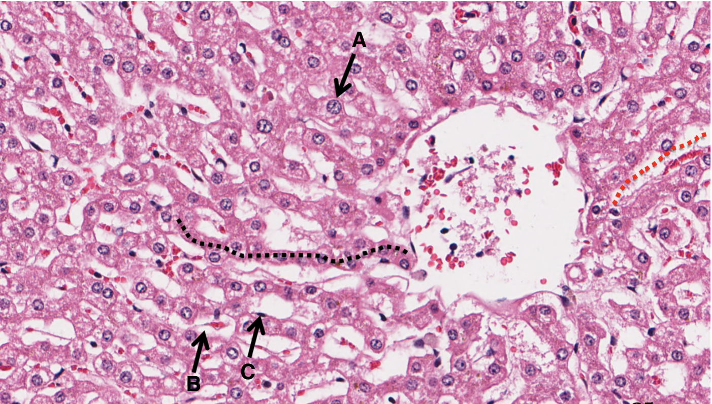 <p>What is A in a liver slide?</p>