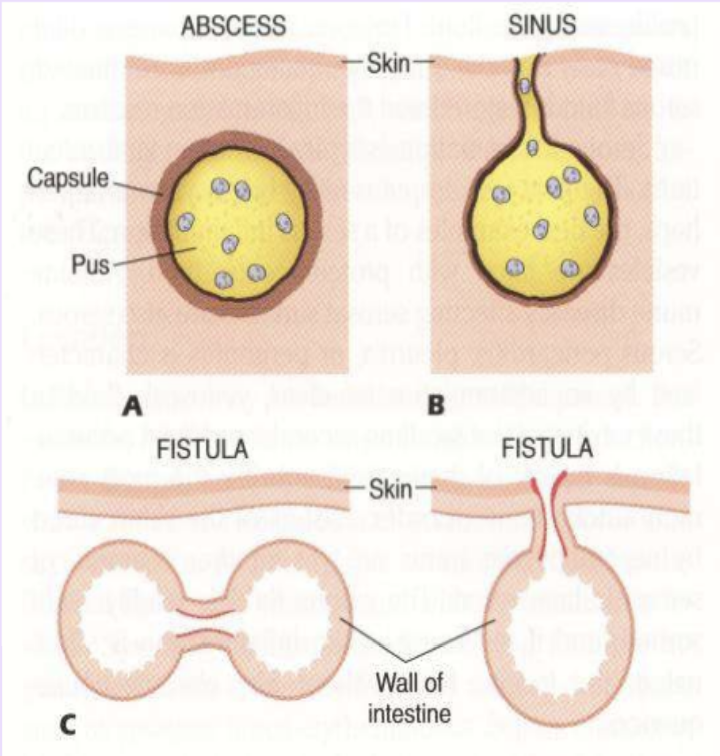 <p>capsule of granulation tissue</p><p>full of pus, doesn’t heal on it’s own. can rupture or form fistula (ex. Crohns)</p>