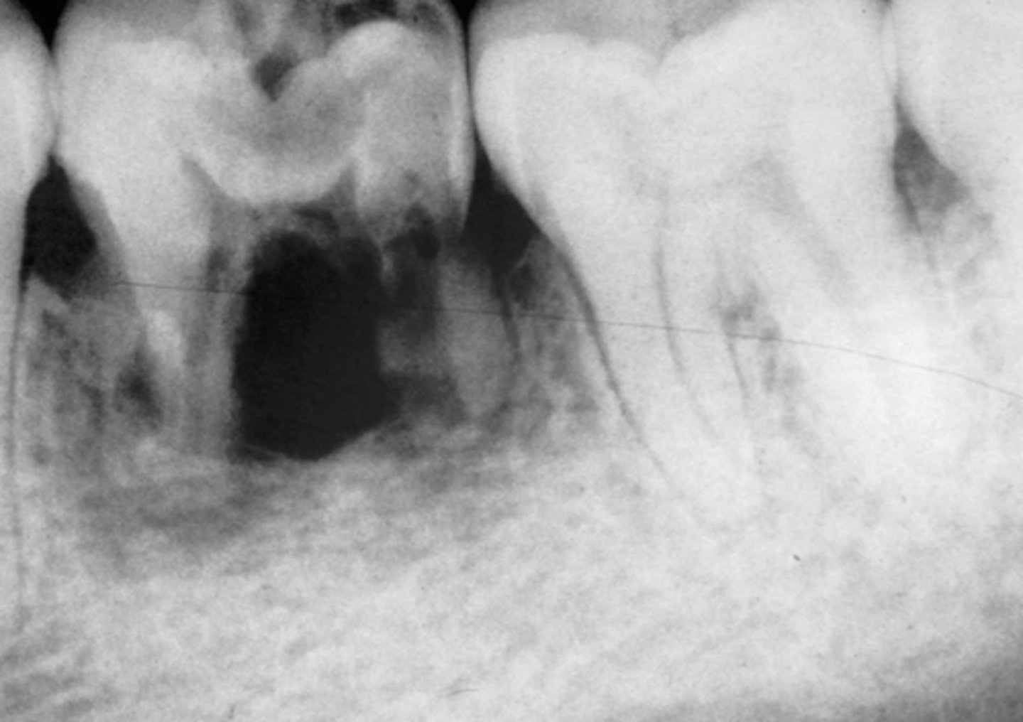 <p>Tumor settles out by tooth and takes blood supply for its own cells</p><p>- Tooth root and bone do not get any nourishment, causes it to resorb</p>