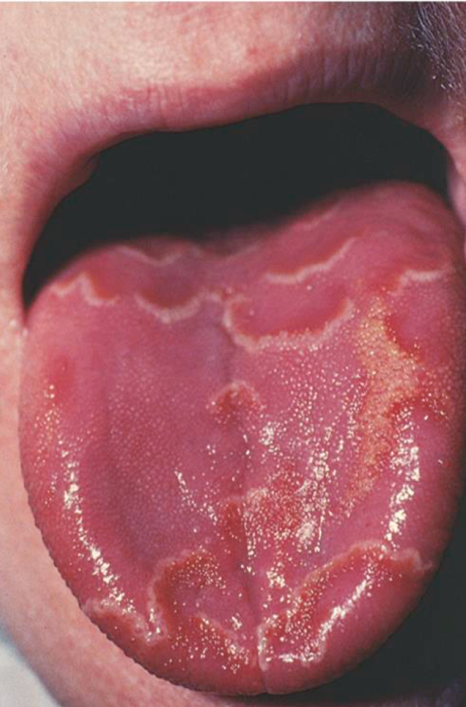 <p>Geographic tongue </p>