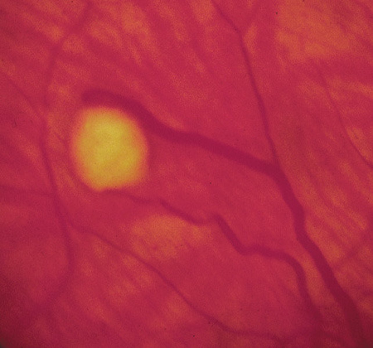 <p>PHKOMAS</p><p>Retinal phakomas, which require no treatment, are a principal criterion for making the diagnosis of tuberous</p><p>sclerosis. Along with adenoma sebaceum and periventricular tubers, they are virtually pathognomonic. Other findings that are typical of tuberous sclerosis include ash leaf spots, shagreen patches, CNS calcifications, renal tumors, cardiac rhabdomyomas, and seizure disorders.</p>