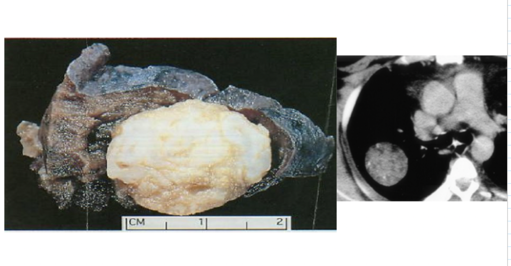 <p>benign or malignant?</p>