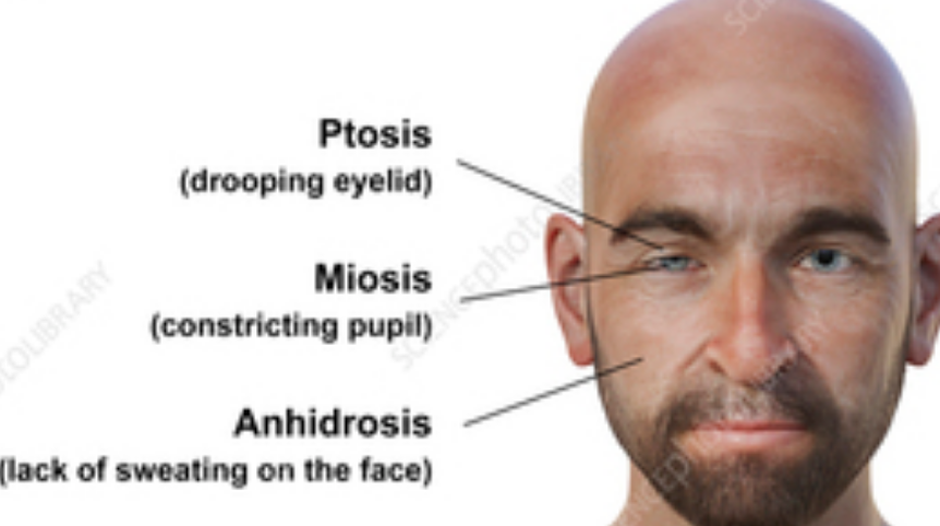 <ol><li><p>ptosis</p></li><li><p>miosis</p></li><li><p>anhidrosis </p></li></ol><p></p>