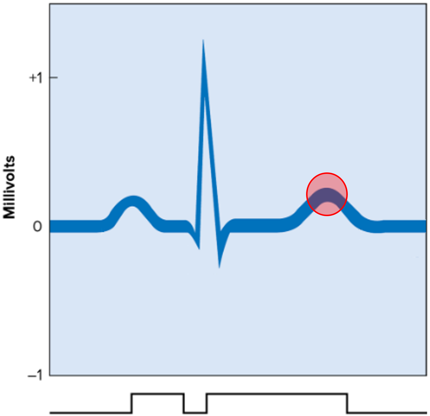 • A deflection wave of the ECG.

• Represents ventricular repolarization.