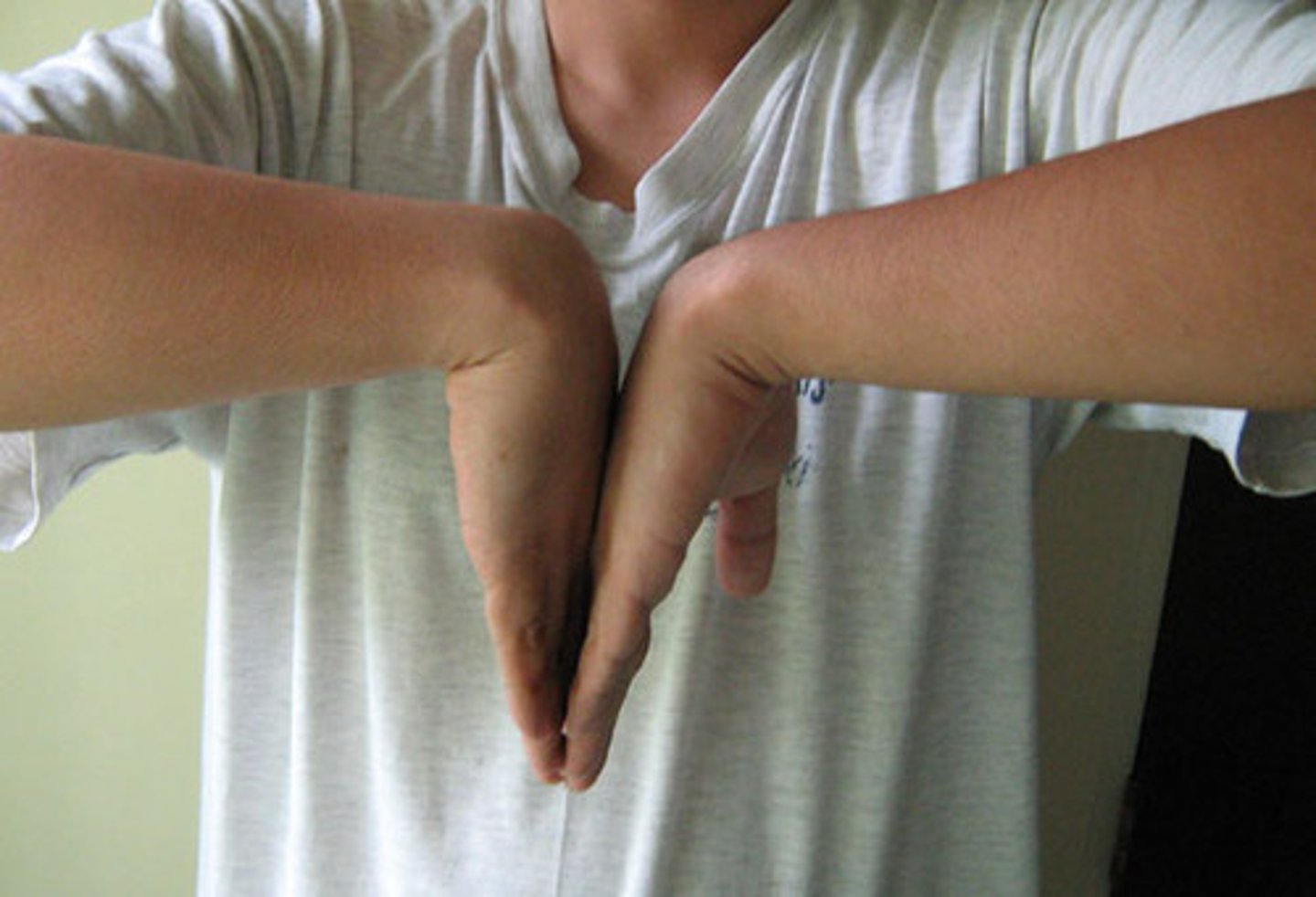 <p>median nerve compression of the carpal tunnel; praying or upside down praying</p>