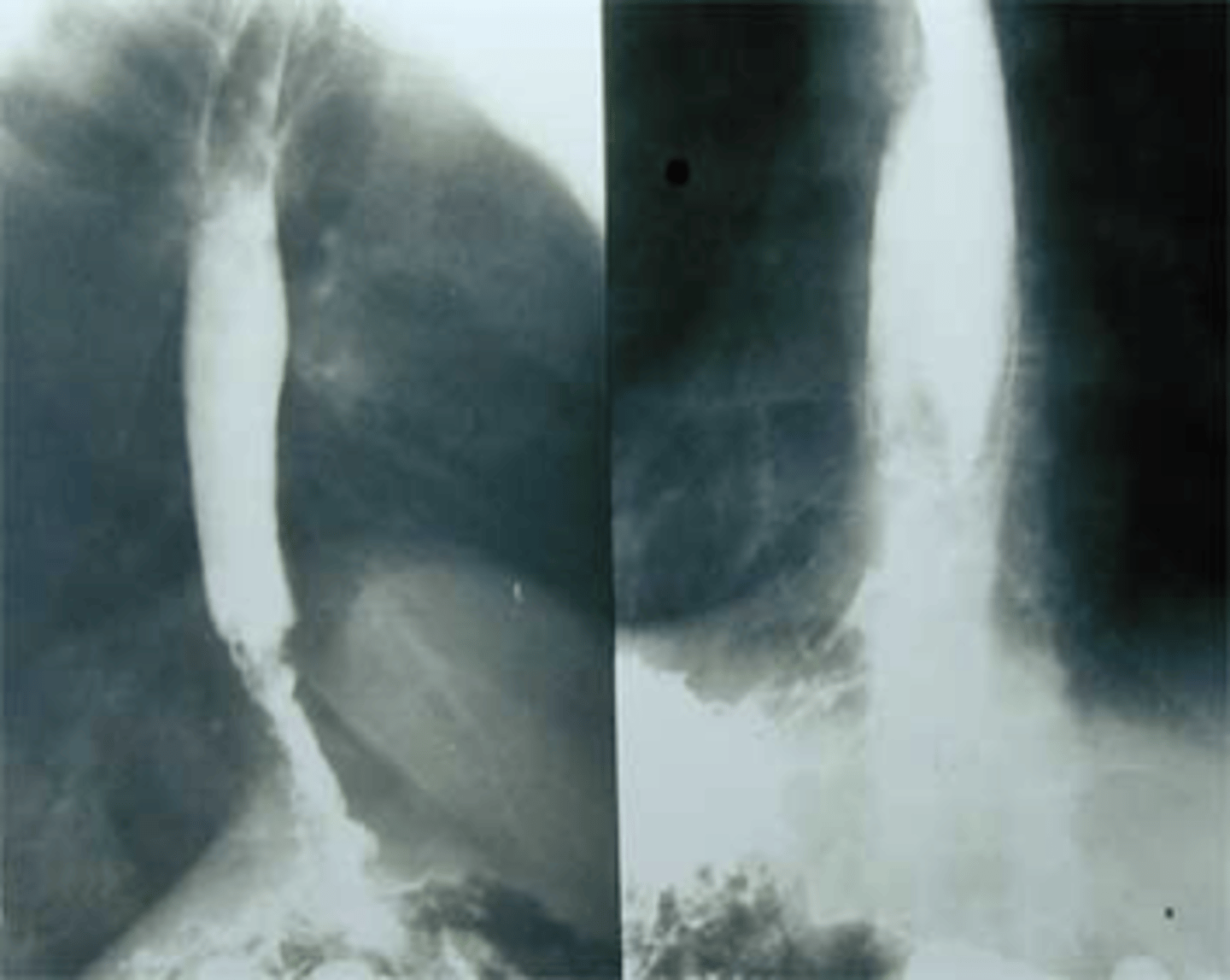<p>Barium Esophagography/Barium swallow (BA swallow, UGI series)</p>
