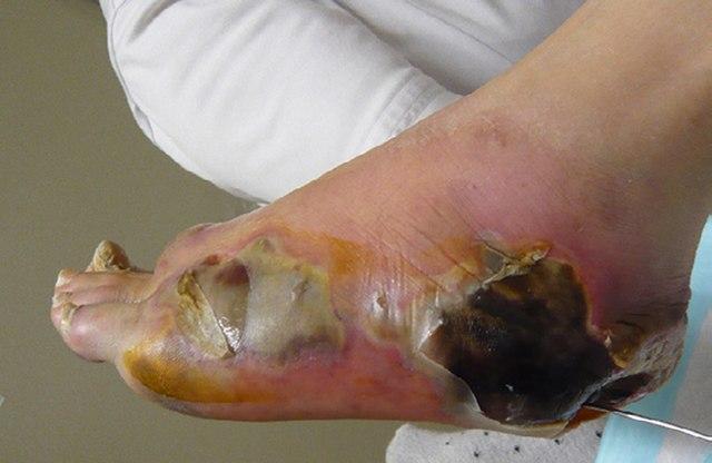 <p>Caused by : colostridum prefringes </p><p>type: gram positive, endospore forming </p><ul><li><p>two main virulence factor : neotxion hydrolunidase and CPB necrosis toxin </p></li><li><p>caused necrotic tissue </p></li><li><p>enters through a cut or lesion on the skin </p></li></ul><p>treatment:</p><p>hybermic chamber or just cutting it off </p>