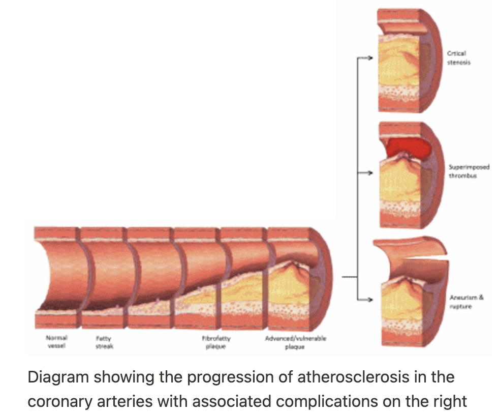 <ul><li><p>Initial endothelial dysfunction is triggered by factors such as smoking, hypertension and hyperglycaemia</p></li><li><p>Results in changes to the endothelium including pro-inflammatory, pro-oxidant, proliferative and reduced nitric oxide bioavailability</p></li><li><p>Fatty infiltration of the sub-endothelial space by low-density lipoprotein (LDL) particles</p></li><li><p>Monocytes migrate from the blood and differentiate into macrophages</p><ul><li><p>These macrophages then phagocytose oxidised LDL, slowly turning into large 'foam cells'</p></li><li><p>As these macrophages die the result can further propagate the inflammatory process</p></li></ul></li><li><p>Smooth muscle proliferation and migration from the tunica media into the intima results in formation of a fibrous capsule covering the fatty plaque</p></li></ul>