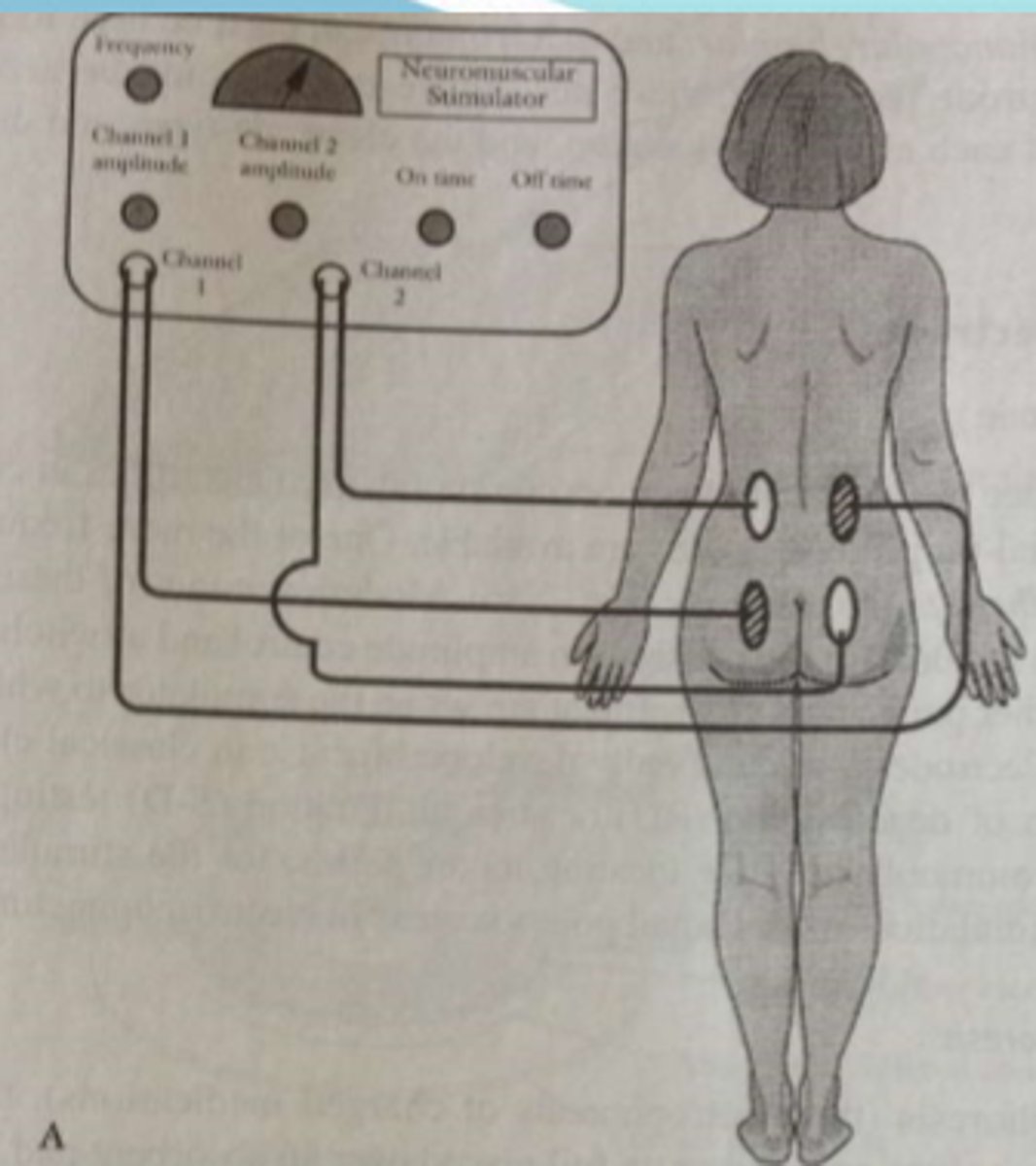 <p>What type of electrical stimulation is depicted?</p>
