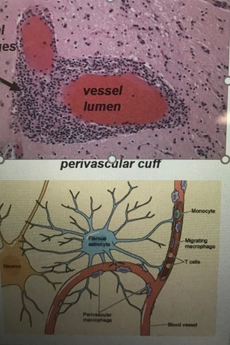 <p>Neurological changes as a result of HIV/AIDS that create cognitive deficits and dementia.</p><p>- ca infect microglia + perivascular macrophages in CNS</p>