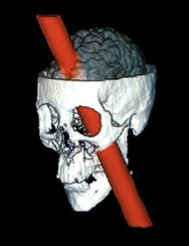 <p>Tragic and bizarre accident&nbsp;</p><ul><li><p>13lbs steel rod impaled</p></li><li><p>landed 80 feet away</p></li></ul><ul><li><p>Personality change </p></li><li><p>taught about the prefrontal cortex of the brain </p></li></ul><p></p>