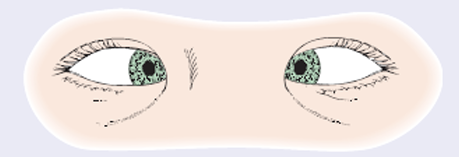 <p>PUPILS WILL APPEAR AT THE INNER CANTHUS</p>