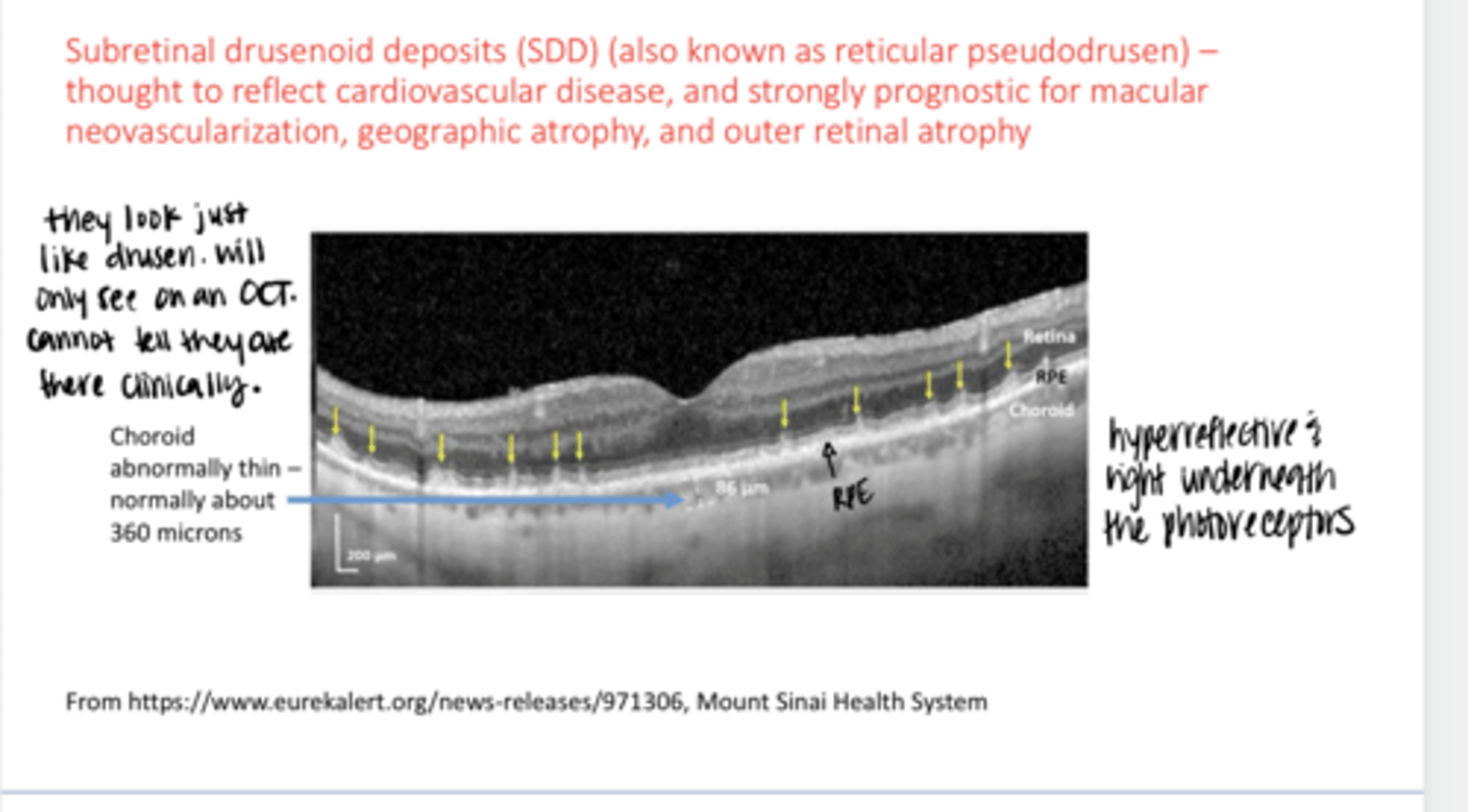 <p>Can you tell that Subretinal drusenoid deposits are there clinically?</p>
