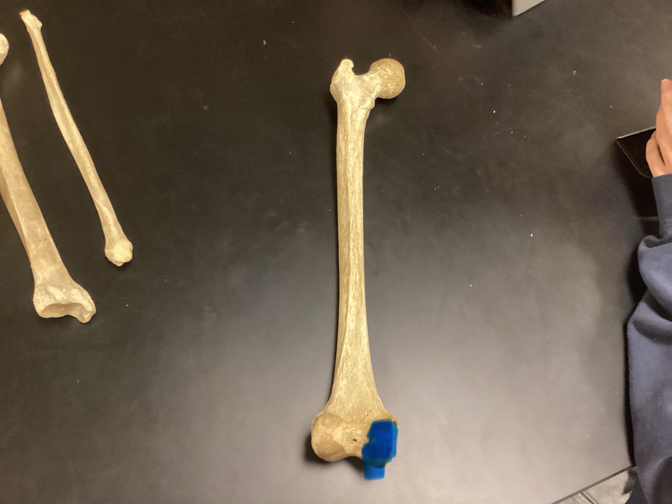 <p>Medial condyle</p>