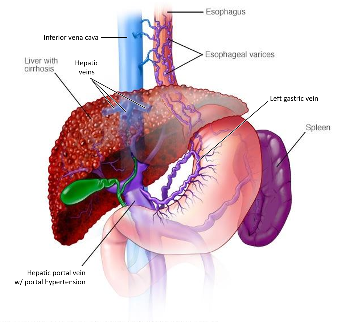 <p>Why do <strong>esophageal veins</strong> become <strong>swollen </strong>in portal hypertension?</p>