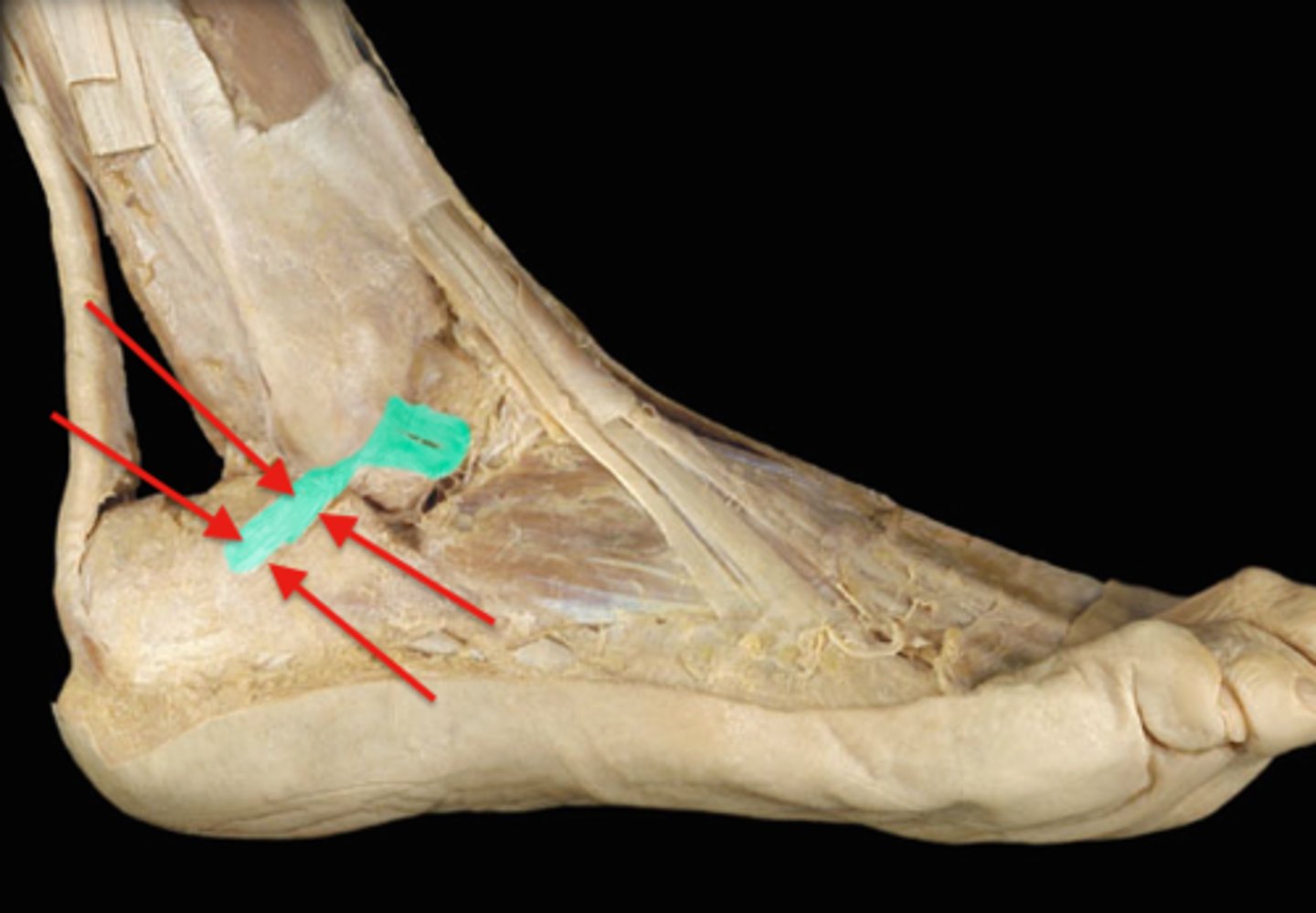 <p>- ligament running from the lateral surface of the calcaneus to the lateral malleolus of the fibula</p><p>- smaller, lateral extra capsular ligament of the ankle</p><p>- covered by the fibulas longs and braves tendons</p>