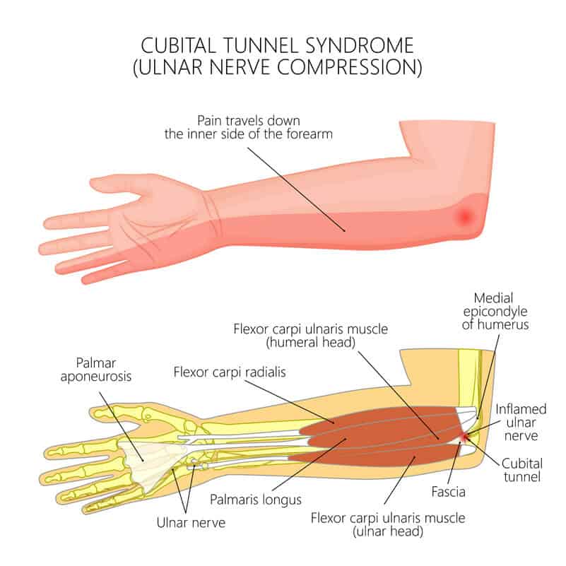 <p>-ulnar nerve compression at elbow</p><ul><li><p>numb at ulnar aspect of forearm</p></li><li><p>pain at elbow with consistent/extreme elbow flex</p></li><li><p>Positive Froment’s sign </p><p><span data-name="high_voltage" data-type="emoji">⚡</span>️easily pull the paper <strong>from</strong> someone’s pinch who has Cubital Tunnel</p></li><li><p>Positive Tinel’s sign at elbow</p></li></ul><p><br>-Conservative tx</p><ul><li><p>elbow splint at 30-60 flex</p></li><li><p>elbow pad</p></li><li><p>Suggest activity mods to extend elbow</p></li></ul><p></p><p>Post op tx </p><ul><li><p>edema &amp; scar management </p></li><li><p>2 weeks: AROM/nerve glides</p></li><li><p>4 weeks: strengthening </p></li><li><p>MCP flexion anticlaw splint if clawing is observed</p></li></ul><p></p>