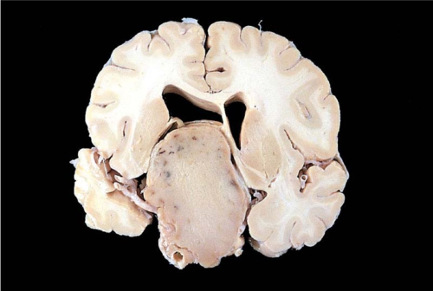 <p>What are the effects of Hyperpituitarism (usually from anterior pituitary adenoma/Pituitary Neuroendocrine tumor aka PitNET)?</p>