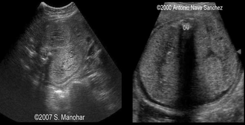 <p>which is usually assoc w/oligohydramnios</p><p>a) spina bifida</p><p>b) autosomal recessive PKD</p><p>c) thanatophoric dwarfism</p><p>d) cleft lip </p>